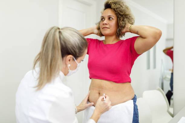 liposuction in NYC